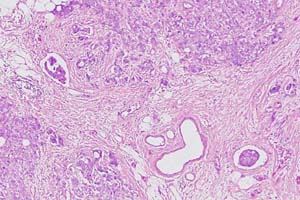 Two foci of lymphatic invasion by carcinoma - the focus on the right is close to a venous channel